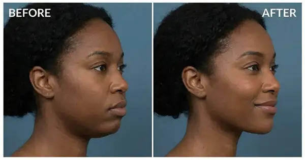 Cryofacial + Hydrofacial Snellville GA Before and After 1