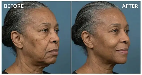 Cryofacial + Hydrofacial Snellville GA Before and After 2