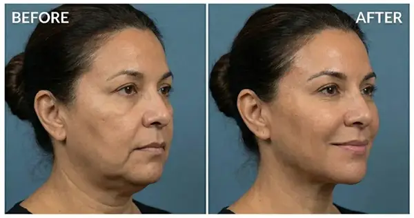 Cryofacial + Hydrofacial Snellville GA Before and After 3